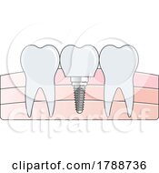 Poster, Art Print Of Tooth Implant And Gums