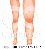 Poster, Art Print Of Swollen Leg