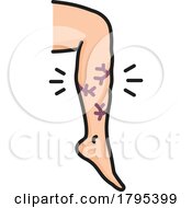 Poster, Art Print Of Leg With Varicose Veins