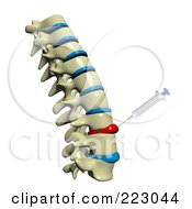3d Spine With Deformed Spinal Discs And A Needle Injecting Medicine Into The Tissue