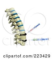 Poster, Art Print Of 3d Spine With Deformed Spinal Discs And Needles Injecting Medicine Into The Tissue - 1