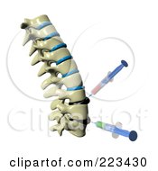 Poster, Art Print Of 3d Spine With Deformed Spinal Discs And Needles Injecting Medicine Into The Tissue - 2