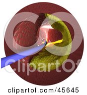 Royalty Free RF Clipart Illustration Of A Scope Passing Through An Artery With Cholesterol Buildup Along The Wall